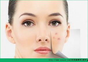 长痘吃蜜瓜,甜蜜解药，肌肤焕新之旅